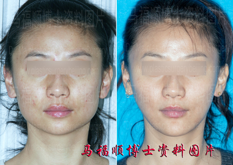 V line shape plastic surgery V line shape plastic surgery