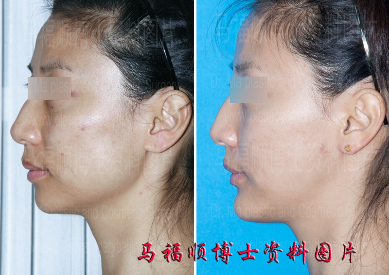 chin sliding forward surgery chin sliding forward surgery