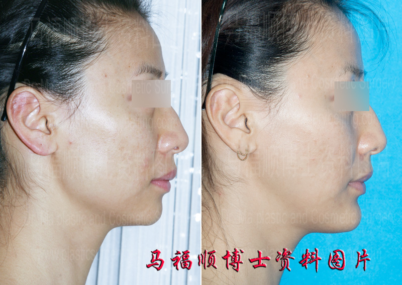 the chin after sliding forward surgery the chin after sliding forward surgery