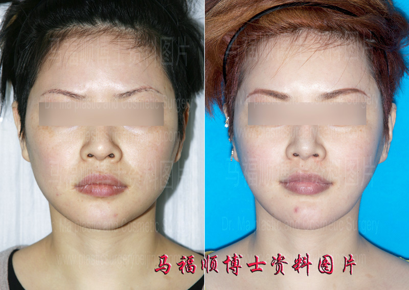 chin forward sliding and mandible reduction surgery