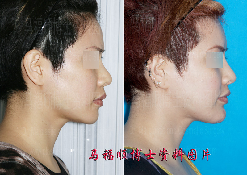 chin forward sliding surgery