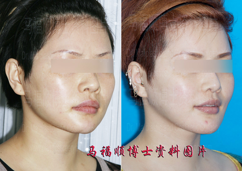 chin implant removal and chin bone forward sliding surgery