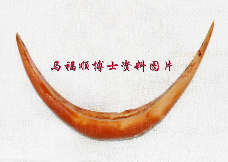the prosthesis for chin augmentation