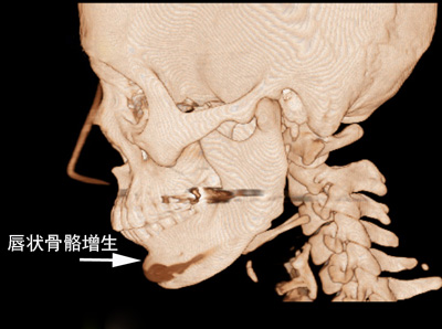 3D CT image of the chin implant