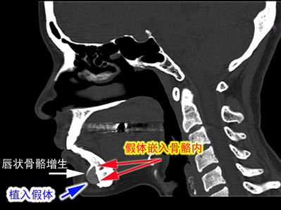 CT image of the chin implant