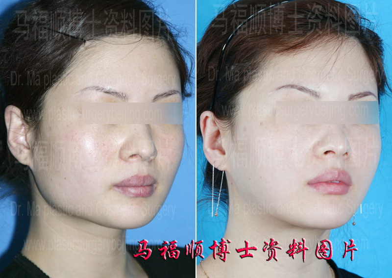 mandible angle plastic surgery