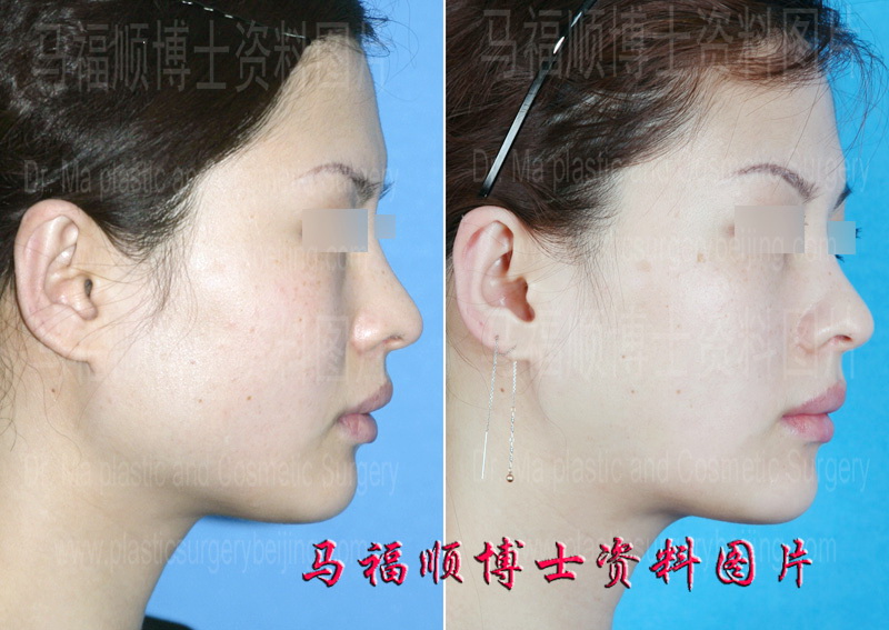 mandible angle reduction profile
