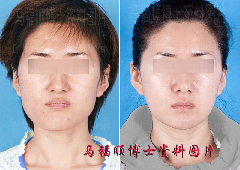 Whole mandible bone reduction and upper jaw advancement surgery Whole mandible bone reduction and upper jaw advancement surgery