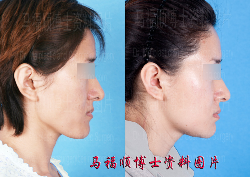 mandible bone reduction mandible bone reduction