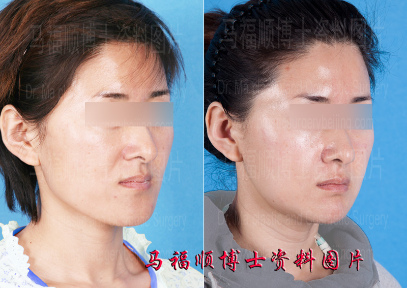 upper and lower jaw surgery upper and lower jaw surgery