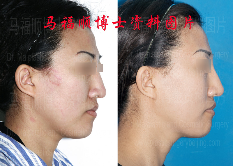 profile of the asymmetric mandible correction profile of the asymmetric mandible correction