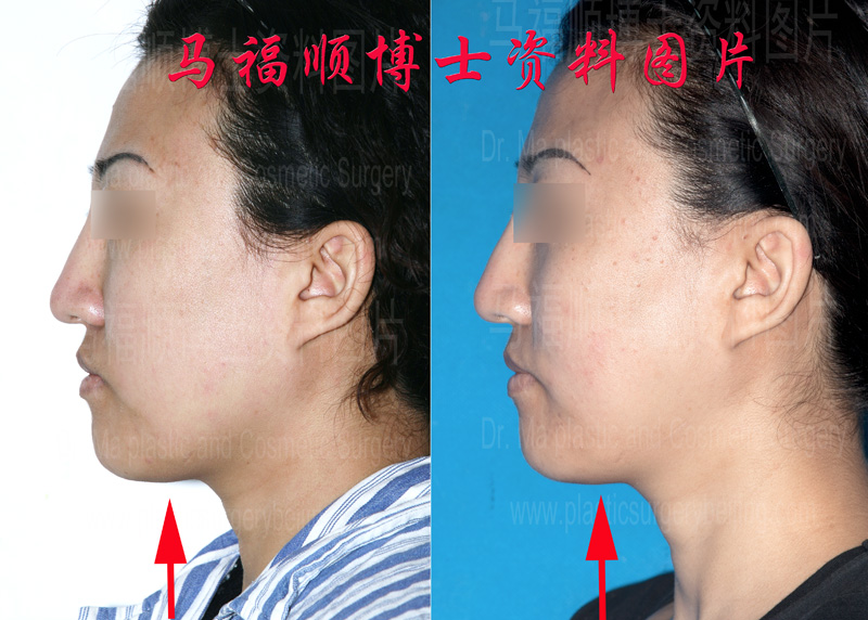 profile of correction and reduction surgery for asymmetric mandible profile of correction and reduction surgery for asymmetric mandible