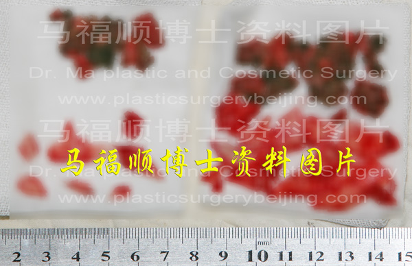 bone and muscle removed from asymmetric mandible reduction surgery bone and muscle removed from asymmetric mandible reduction surgery