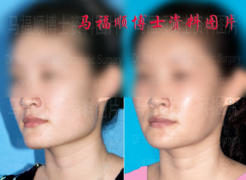 before and after photos of whole mandible reduction surgery
