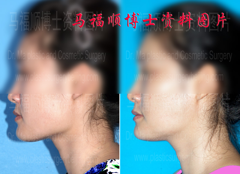 whole mandible reduction lateral veiw