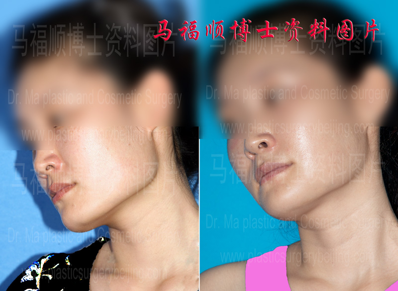 lower mandible line after whole mandible reduction surgery
