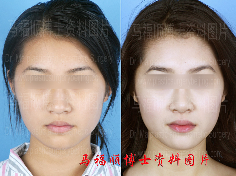 Nasal bone reduction surgery before and after photos