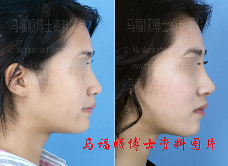 profile view after nasal bone reduction surgery