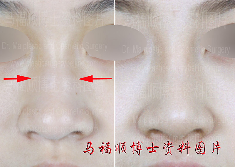nasal bone reduction surgery