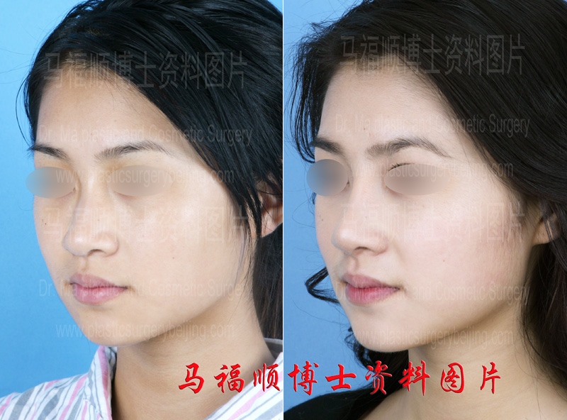 oblique view after nasal bone reduction surgery