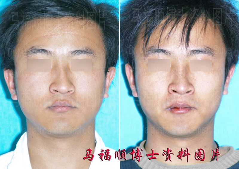 correctiv surgery of deviated nose