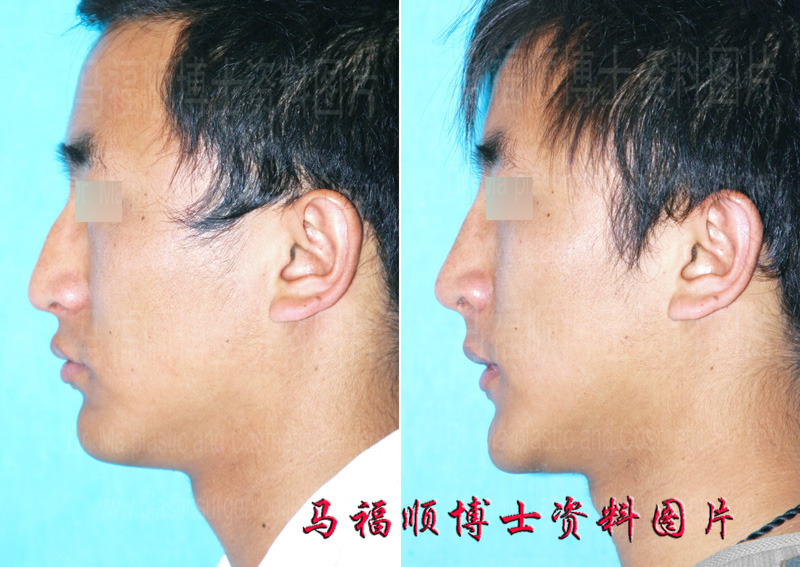 corrective surgery of deviated nose and hump nose