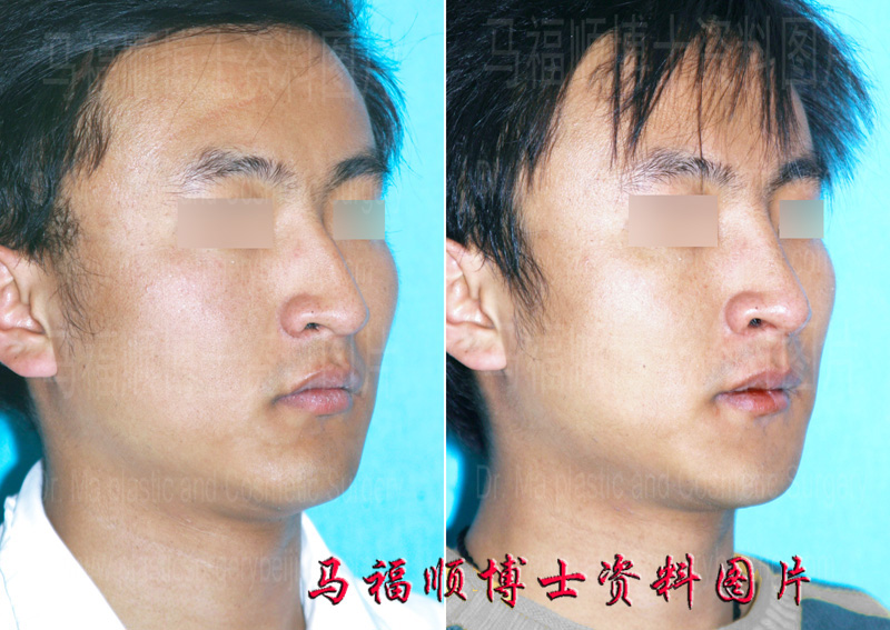 photo of correctvie surgery of the deviated nose