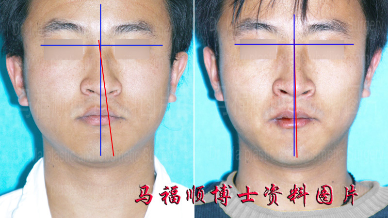 photo analysis of deviated nose correction