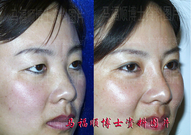 augmentation rhinoplasty
