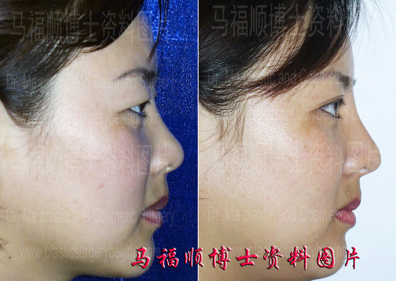 rhinoplasty and blepharoplasty