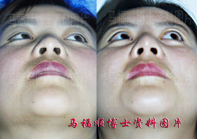 silicon nasal implant chin up position