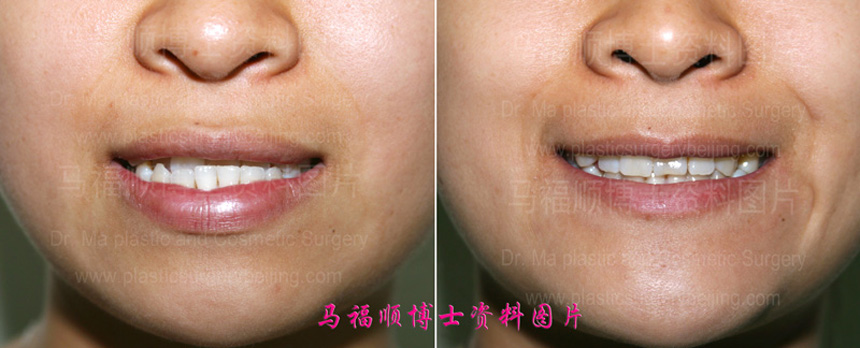 occlusion changes after underbite correction surgery