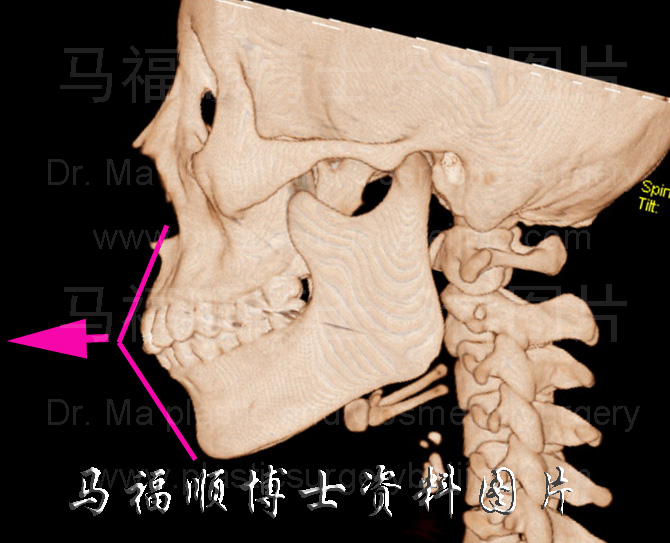 mouth protrusion CT image