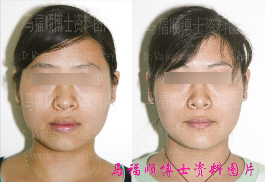before and post photos of minor underbite correction surgery