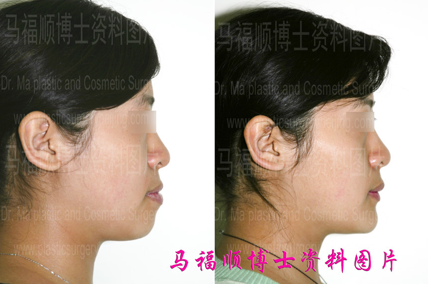 before and after pictures of minor underbite correction surgery