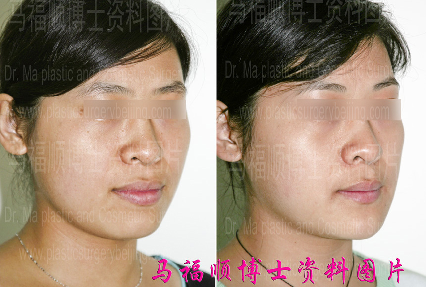 minor underbite correction surgery