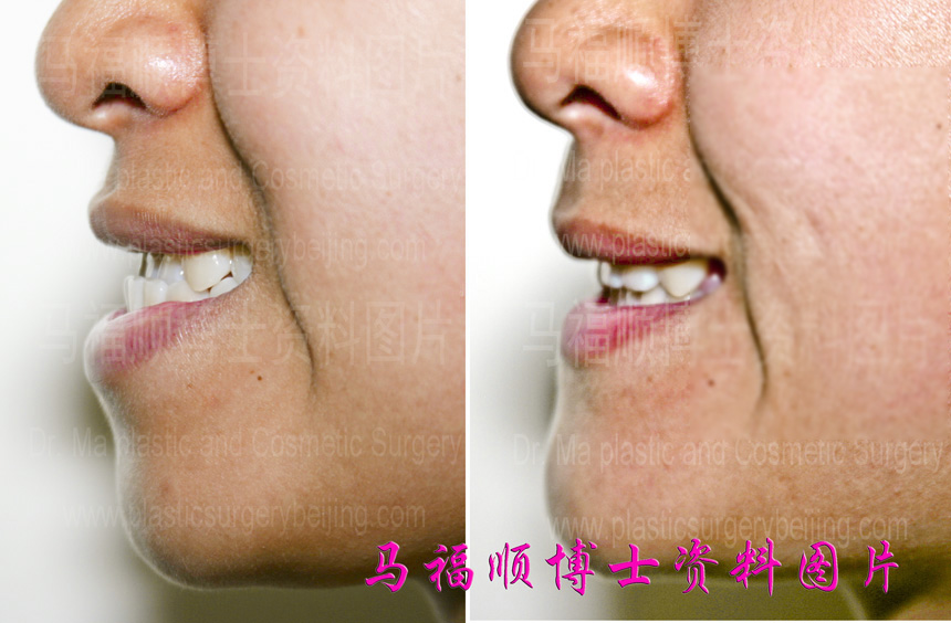 occlusion change after underbite correction surgery