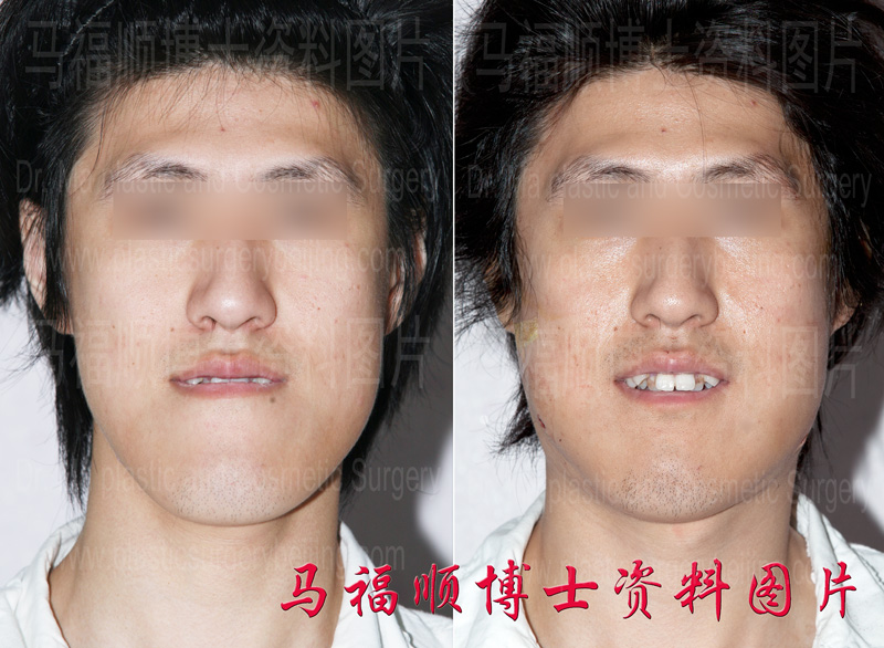 mandible protrusion surgery photos