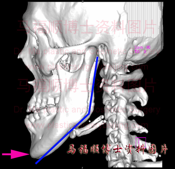 CT image of protruding mandible