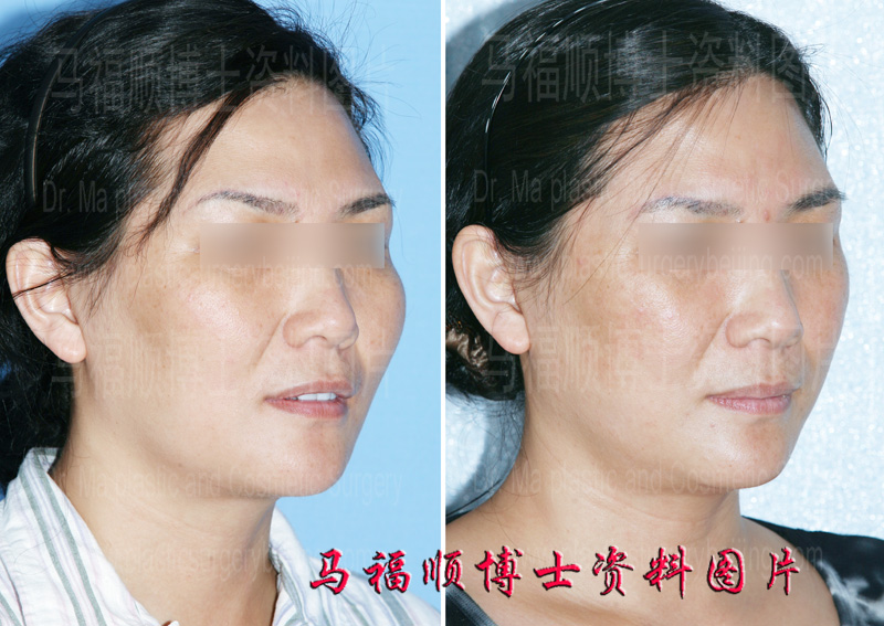 cheekbone reduction