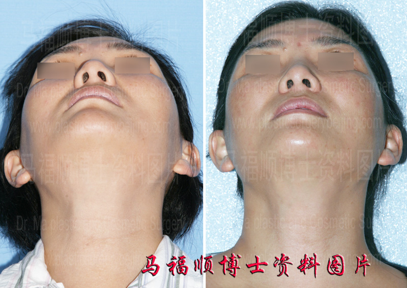 cheekbone reduction chin up position
