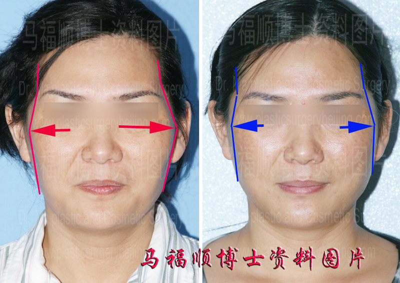 asymmetric high cheekbone correction
