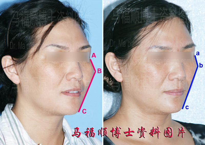change of the zygomatic process point after cheekbone reduction