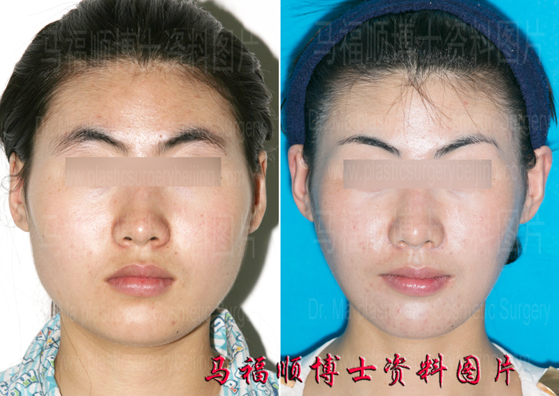 facial reduction