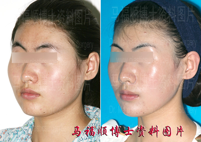facial reduction before and after surgery photos