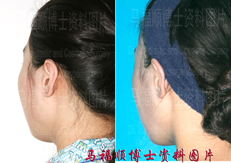 the zygomatic process is smaller after facial reduction surgery