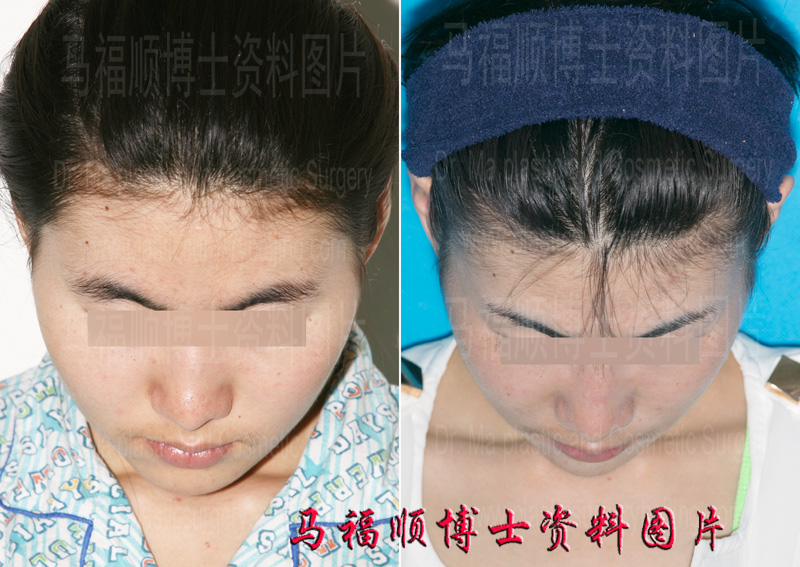 effect of zygoma and zygomatic bone reduction