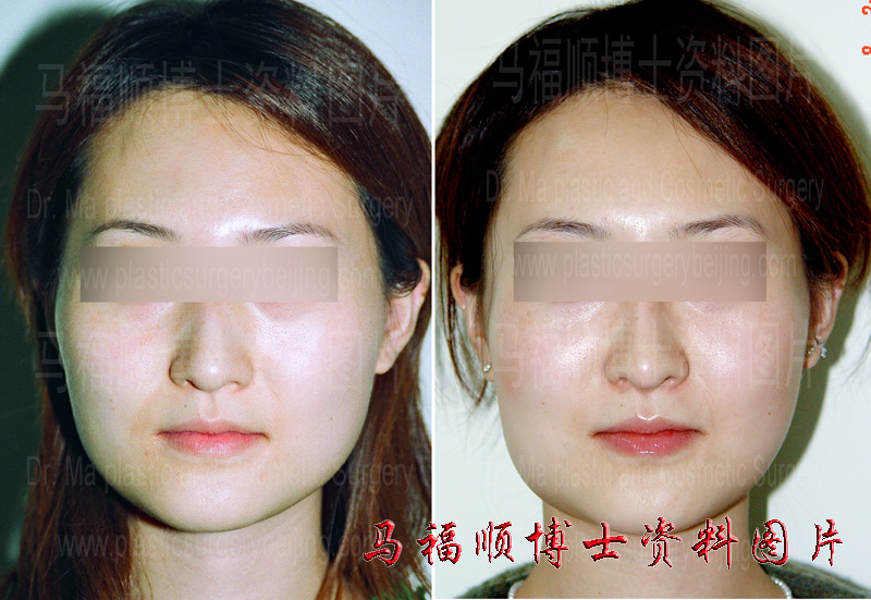 reduction plastic surgery of asymmetric zygomatic bone and zygomatic arch
