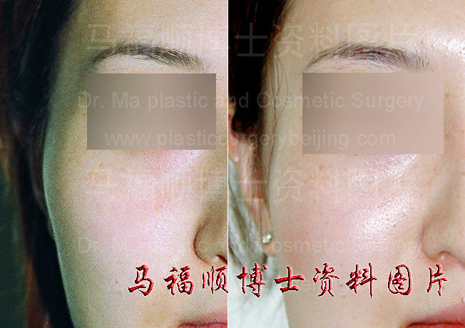 right side facial change after the zygomatic bone and zygomatic arch reduction surgery