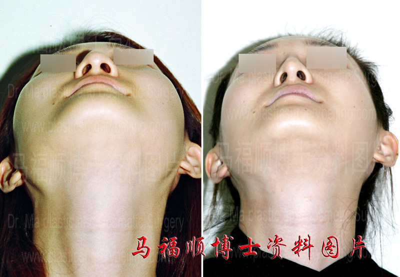 chin up position comparison photos after zygomatic bone and zygomatic arch reduction surgery